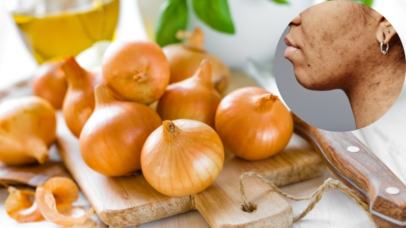 Chiết xuất hành tây giúp làm sáng da, mờ thâm