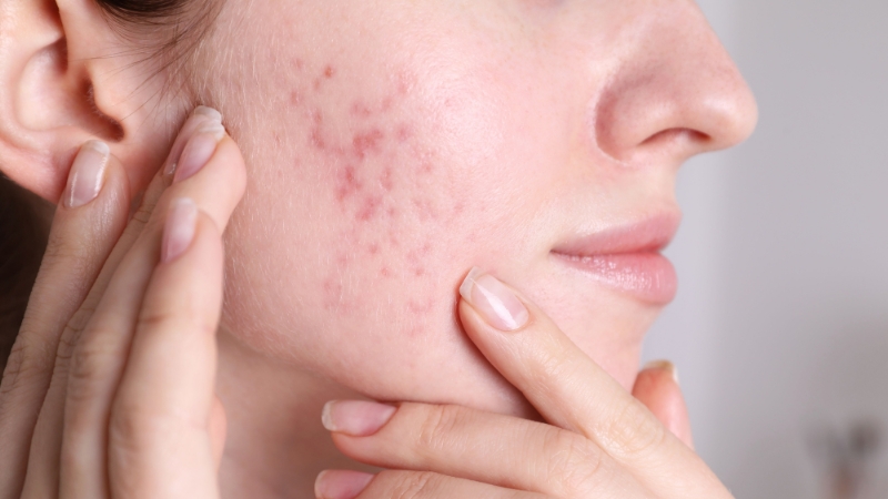 Retinol có trị thâm mụn không?