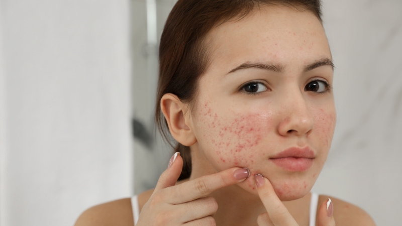 Nguyên nhân gây mụn ở tuổi dậy thì
