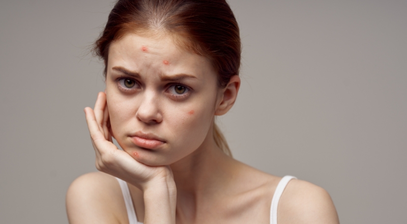 Mụn viêm có nên dùng BHA không? Cách dùng BHA an toàn