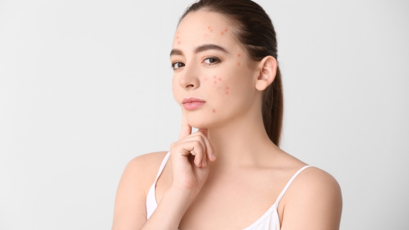 Nguyên nhân da bị mụn viêm
