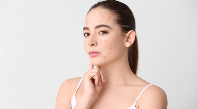 Da mụn là gì? Vì sao da bị mụn? Cách điều trị và phòng tránh hiệu quả