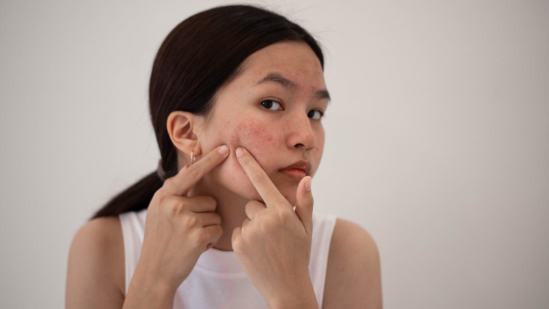 Da mụn là gì?