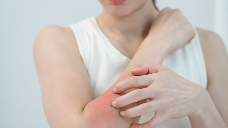 Da nhạy cảm thường xuyên bị ngứa