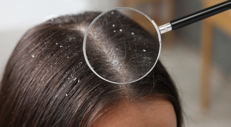 Da đầu bị gàu: 7 Nguyên nhân và cách trị hiệu quả