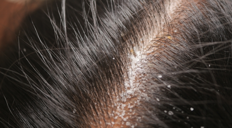 Gàu hình thành do bong tróc tế bào da đầu nhanh hơn bình thường