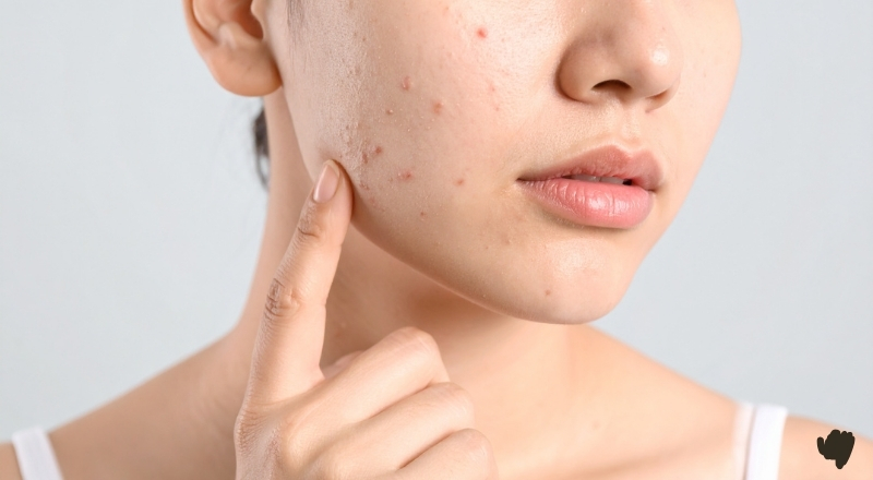 Chiết xuất diếp cá hỗ trợ kháng khuẩn, làm dịu và ổn định da mụn