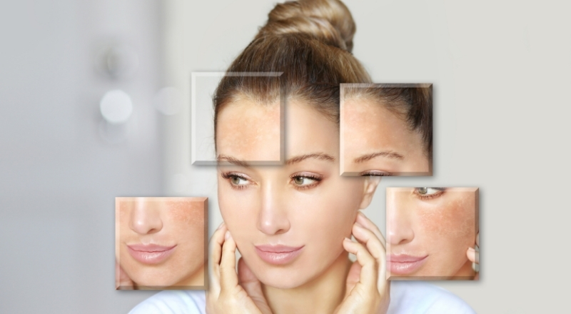 Hiệu quả dưỡng trắng bị giới hạn bởi nền melanin và tình trạng da