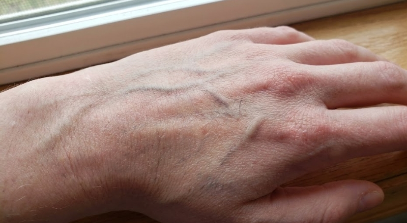 Da mỏng sau dưỡng trắng chủ yếu do thiếu phục hồi và bảo vệ da