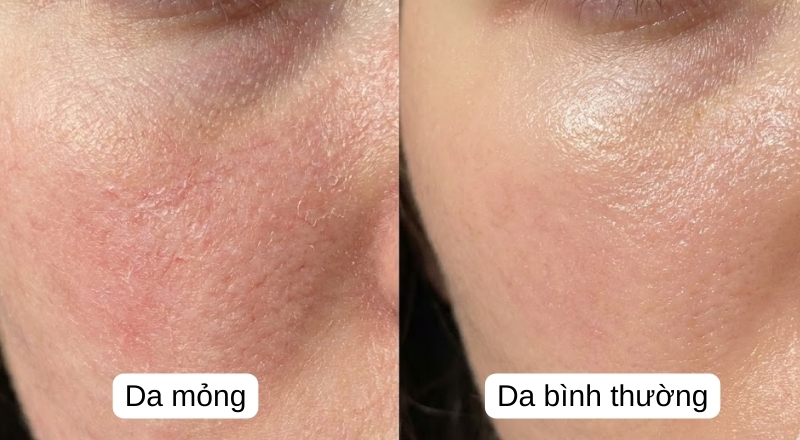 Da mỏng xuất phát từ tổn thương hàng rào bảo vệ da kéo dài