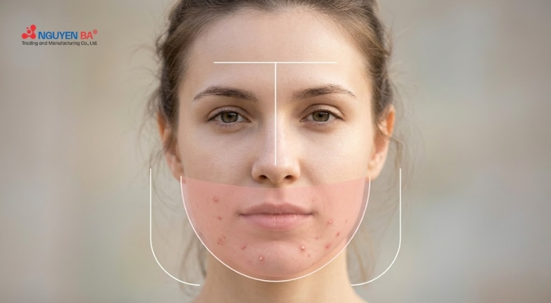Mụn nội tiết thường xuất hiện vùng cằm, quai hàm và tái phát theo chu kỳ