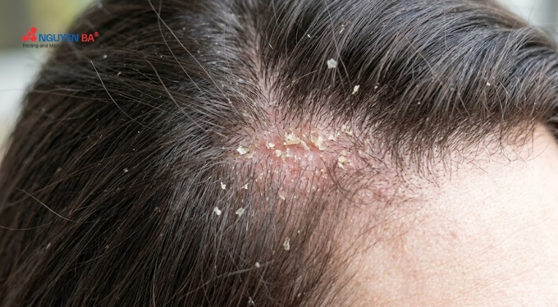 Gàu ngứa da đầu xuất phát từ nấm, dầu thừa và kích ứng hóa chất