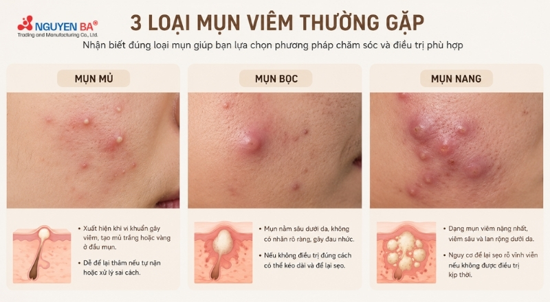 Nhận biết đúng loại mụn giúp lựa chọn cách chăm sóc hiệu quả